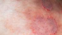 A Drug-Resistant Ringworm Fungus is Surging Across the Globe, Scientists Warn