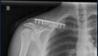 Kaden Hopkins returns to saddle with more metal in shoulder