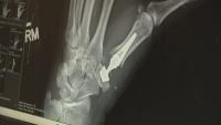 University Orthopedics performs first thumb replacement in Rhode Island