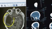 Australian scientists develop breakthrough treatment for deadly brain cancers