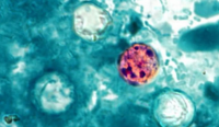 Patient count in Cyclospora outbreak in Michigan at more than 14,700