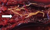 The unsavoury truth about your sushi: Scientists discover 96% of tuna are infected with parasitic worms
