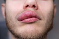 Argo points to swelling disorder drug’s differentiated profile on Phase II success
