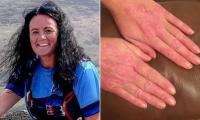 I was tortured by psoriasis for 20 years. Then I finally found a simple cure that really works - and it saw me lose 42 lbs too WITHOUT medication. Everyone plagued by itchy red skin patches should make these easy lifestyle tweaks