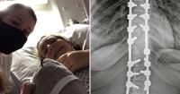 Bishop Auckland twins had to learn how to walk again after major spinal surgery