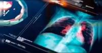 Global lung cancer screening lessons offer roadmap for India: AIIMS expert