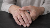 Arthritis report estimates annual economic, social burden at $142.4 billion