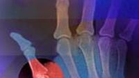 Arthritis crisis: Research shows the individual and societal costs of the disease are staggering