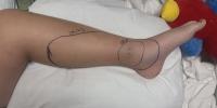 9-year-old Morrisville boy recovers at home after copperhead bite at Missouri lake