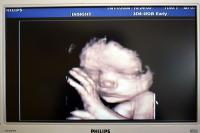 Activists Target Healey’s Abortion Law With Emergency Repeal Push