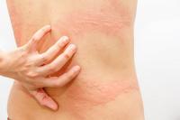 <![CDATA[Cholinergic urticaria: Hives caused by heat and what can be done about it]]>