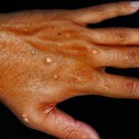 Mpox: A Zoonotic Disease at the Heart of Animal and Human Health -By Dr. Moris Umoru, DVM