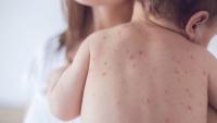 Bangladesh measles death toll crosses 1,000