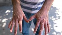 Fears of fresh mpox outbreak in Spain as new case confirmed in holiday hotspot