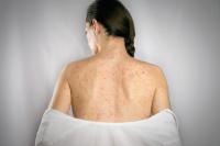 Halton Public Health confirms second case of measles in Milton