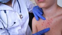 Health department: Kentucky sees largest measles outbreak since 90s