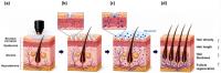 APR Says Beauty Device Technology Shows Promise for Hair Loss Treatment