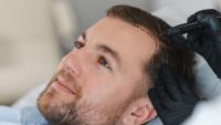 Top 10 Best Hair Transplant Clinics in Turkey