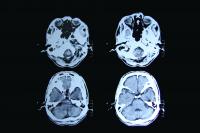 UBC scientists uncover why some Huntington disease patients decline years earlier