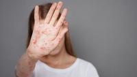 Pennsylvania Officials Report Yet Another Death Linked to Measles as Outbreak Grows