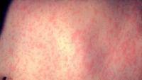 Jackson County health officials confirm measles case, identifies possible exposure locations
