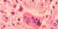Health officials confirm case of measles in Jackson County