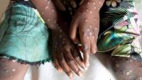 Africa Accounts For 75% Of Global Mpox Cases In July – WHO