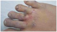 Medical Negligence: Kochi Hospital Allegedly Turns Away Boy With Nail in Foot!