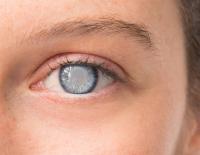 European registry shows continued improvements in cataract surgery outcomes