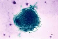 Pennsylvania reports fourth measles-related death, the most in US in decades