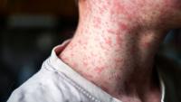 Clinicians Should Be on Alert for Measles in Adults