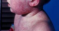 Health officials identify possible measles exposures at two Morehead medical facilities