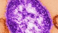 Health officials confirm measles case in Marathon County
