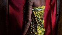 11 African countries record 1,153 mpox cases in six weeks