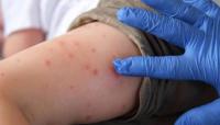 Pennsylvania reports most measles death in US over 30 years: Here's update