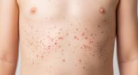 Pennsylvania reports fourth measles death as US outbreak grows
