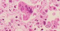 Measles in Wisconsin: New case confirmed in Marathon Co., 164 total cases as of Sept. 15