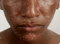 Skin diseases on the rise among children in North Darfur’s Abdelshakur