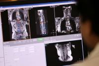 Health Rounds: New dye for MRI exams detects lung cancer earlier