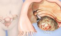 Ovarian cancer claims 30 Namibians in 2024