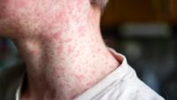 Delaware health officials warn of measles exposure in greater Rehoboth area