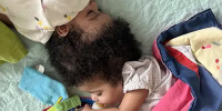 Conjoined twins separated at St. Louis hospital are reaching new milestones