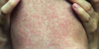 Maine CDC warns of measles exposure at Waterville urgent care