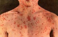 Maine CDC Reports Measles Case at Waterville Urgent Care Center