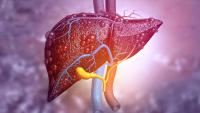 Middle age disease ‘silently’ affecting one in FIVE Brits and fuelling deadly cancer – are you at risk?