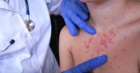 Maryland health officials warn of possible measles exposure at 3 Ocean City locations