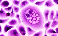 Researchers use genetically engineered immune cells to put a child's metastatic cancer into remission