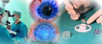 Chiang Rai Hospital Hits Milestone With Cornea Transplants