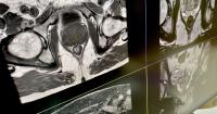 Prostate biopsy success is highly dependent on MRI quality, study shows