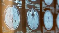 Immunotherapy for MS: No difference between the cheap and the expensive variant